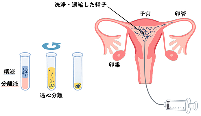 人工授精の図解