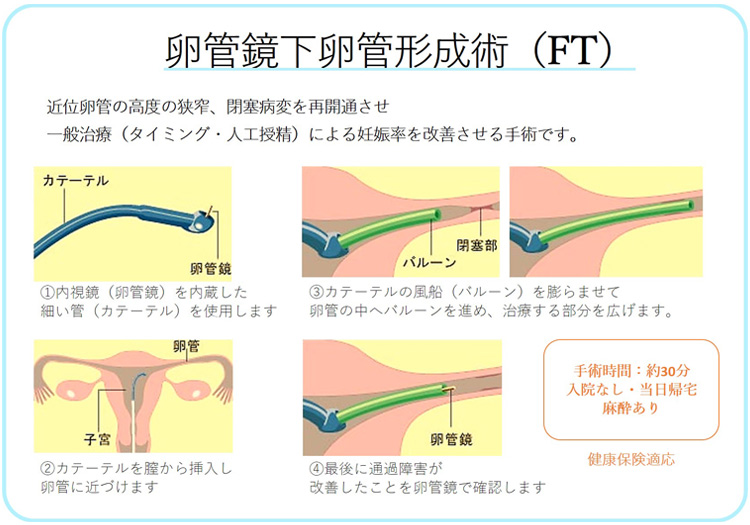 卵管鏡下卵管形成術（FT）とは