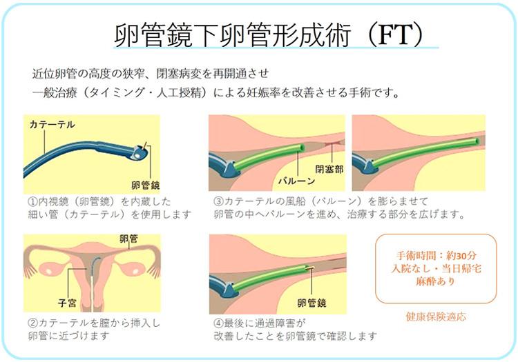 卵管鏡下卵管形成術(FT)とは