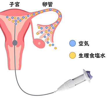 超音波下子宮卵管造影検査(フェムビュー)