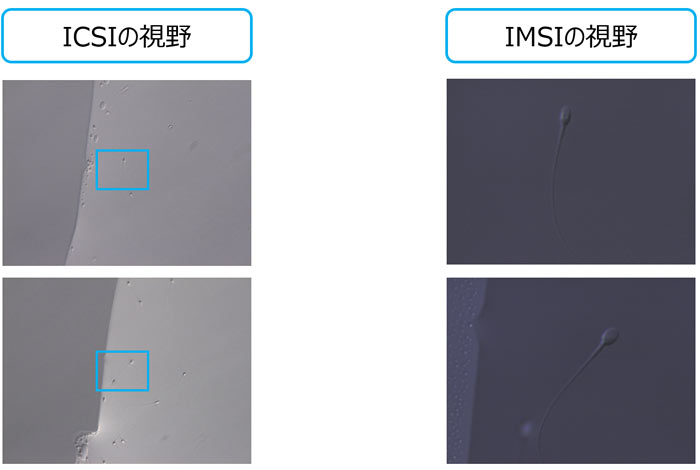 形態学的精子選択術(IMSI)